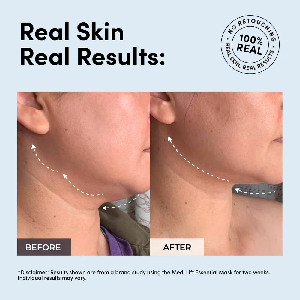 Medi Lift EMS Face Sculpting Mask (patented and wireless)